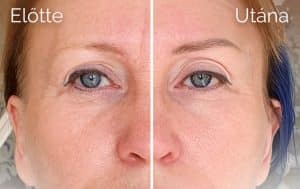 anti-aging sminktetoválás