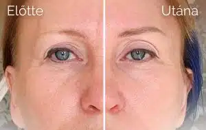 anti-aging sminktetoválás