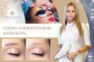 lézeres tetováláseltávolítás a Patkós Alexandra Exclusive Beauty Szalonban