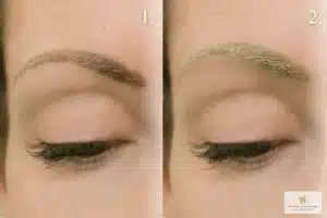 lézeres tetováláseltávolítás a Patkós Alexandra Exclusive Beauty Szalonban